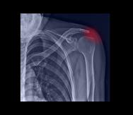 Los depósitos de calcio en el hombro forman calcificaciones que pueden causar mucho dolor.
