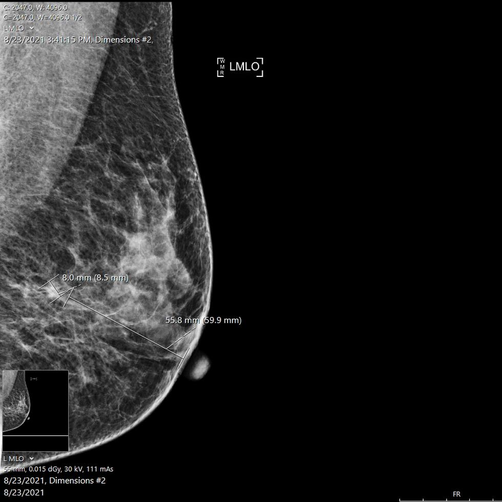 Hoy en día, existe la mamografía 3D-tomosintesis, una nueva herramienta de evaluación diseñada para la detección temprana del cáncer de seno.