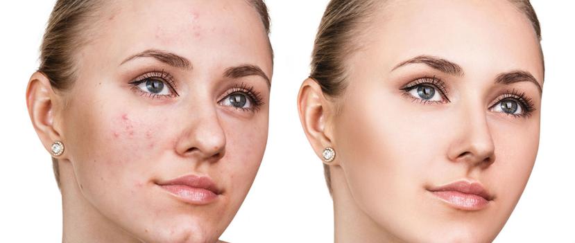 Para tratar las marcas de acné y cicatrices, primero tienes que aprender a identificarlas. (Shutterstock)