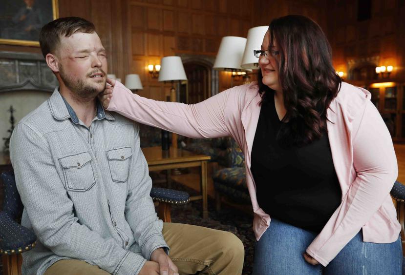 Lilly Ross toca el rostro de Andy Sandness, a quien le trasplantaron el rostro de su marido el 27 de octubre en la Clínica Mayo de Rochester, Minnesota. (AP / Charlie Neibergall)