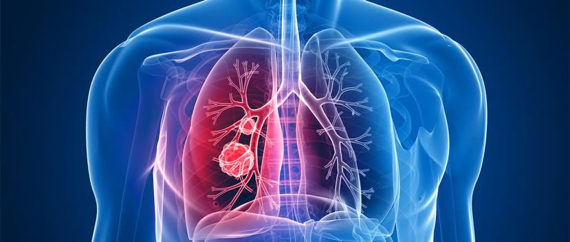 El acceso limitado a exámenes médicos significa que muchos tumores de pulmón generalmente se detectan en etapas avanzadas. (Shutterstock)