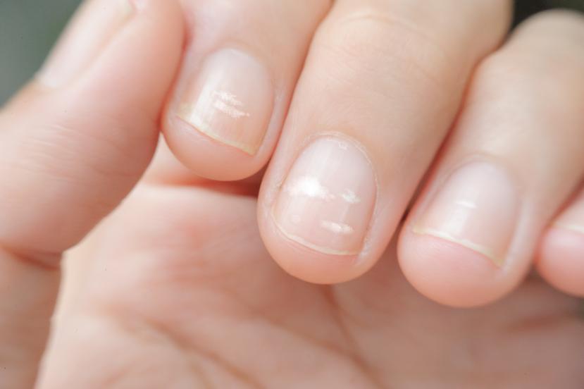 Hay que consultar a un médico siempre que notemos algo fuera de lo común en las uñas. (Shutterstock)