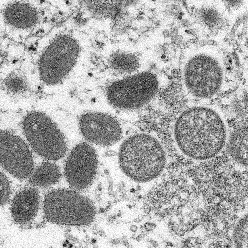 La "viruela del mono", una enfermedad que rara vez aparece fuera de África, ha sido identificada por las autoridades sanitarias de Europa y Estados Unidos. (CDC)