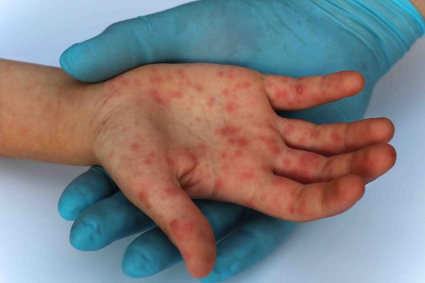 Fiebre alta, tos, congestión nasal, conjuntivitis y sarpullido son algunos síntomas del virus del sarampión. (Shutterstock)