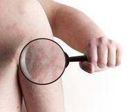 La psoriasis es una condición mediada por el sistema inmune y esto hace que se produzcan placas inflamatorias en las capas altas de la piel. (GFR Media)