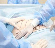 La liposucción fue el procedimiento quirúrgico más frecuente en 2022 como en 2021, con más de 2.3 millones de procedimientos.