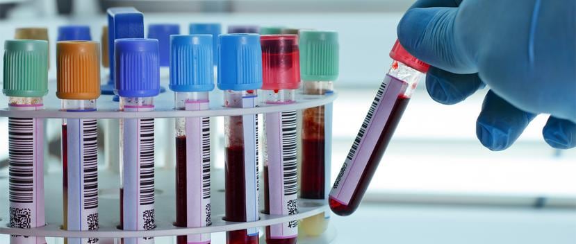 Antes de que la prueba pueda usarse, los investigadores deben determinar qué nivel de neurofilamento en sangre es demasiado alto. (Shutterstock)