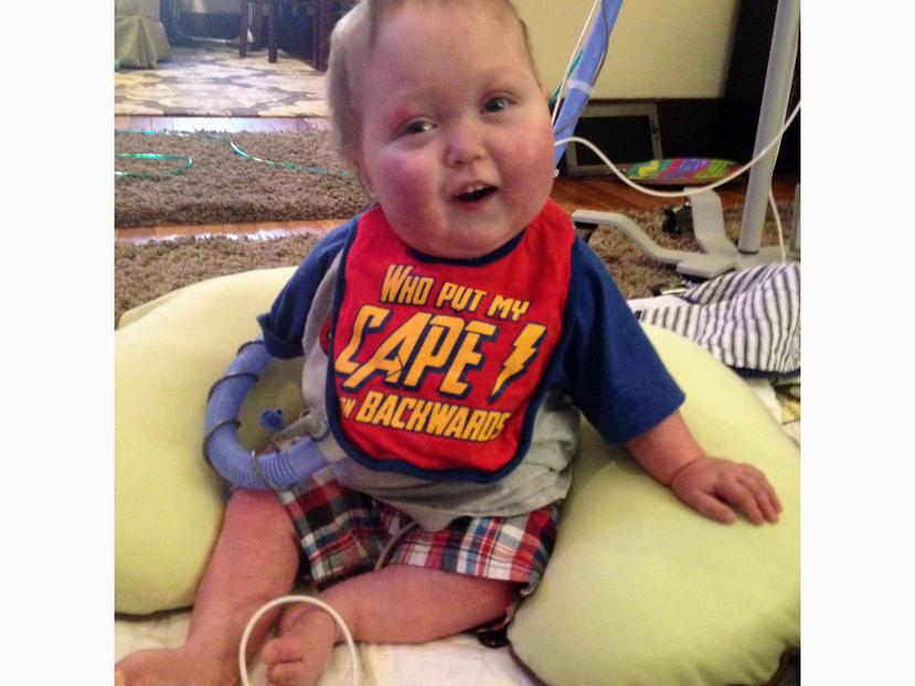 El niño Ian Orbich, de apenas 17 meses de nacido, fue uno de los bebés con defectos en la vía respiratoria que recibieron una prótesis por parte del equipo de la Universidad de Michigan. (AP)