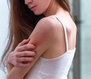 Los efectos de la psoriasis se manifiestan mayormente en el cuero cabelludo, los codos y las rodillas.