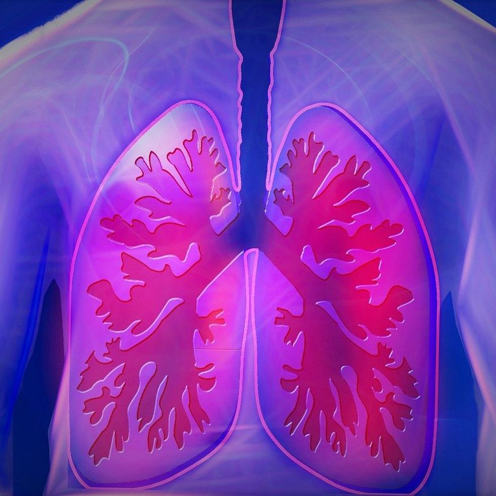La nueva enfermedad provoca lesiones pulmonares similares a una enfermedad llamada bronquiolitis obliterante. (kalhh / Pixabay)