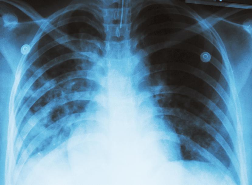 La tuberculosis es una enfermedad que se transmite de persona a persona a través del aire y cuyo tratamiento puede durar un año. (GFR Media)