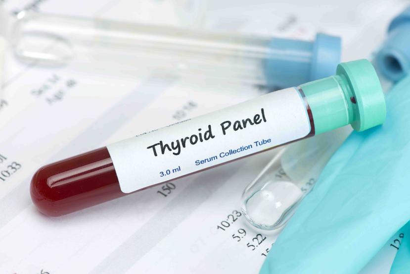 Existen varias pruebas de sangre que pueden detectar alguna condición en la tiroides. (Foto: Shutterstock.com)