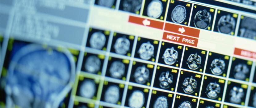 Los científicos compararon sus imágenes cerebrales con las de quienes no habían vivido este fenómeno. (Shutterstock)
