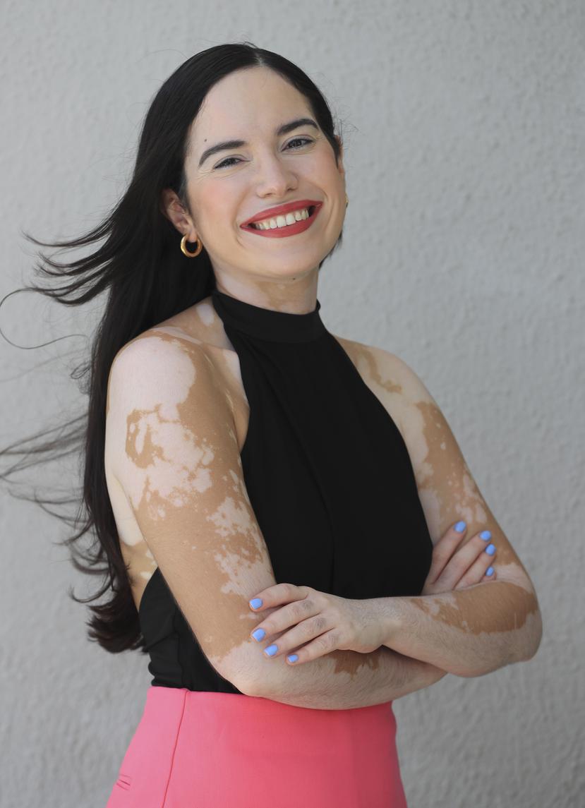 Ashly Carrasquillo fue la creadora del evento Vitiligo Day.