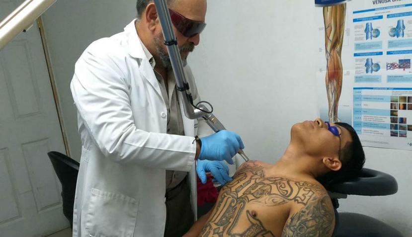 El doctor Morales remueve con láser los tatuajes de un paciente en El Salvador (La Nación / GDA).