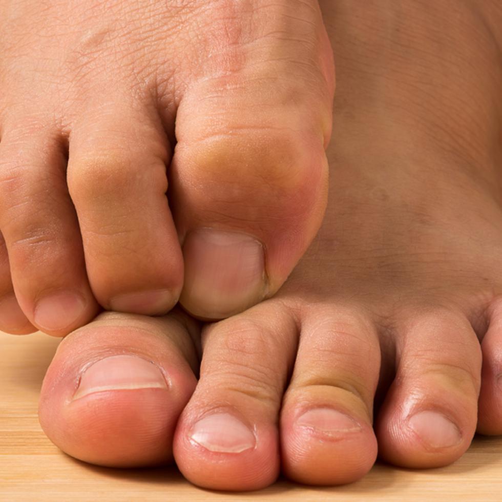 La infección del pie de atleta y los hongos en las uñas de los pies son muy comunes. Se pueden contraer en duchas o piscinas, aunque también puede haber otras causas.