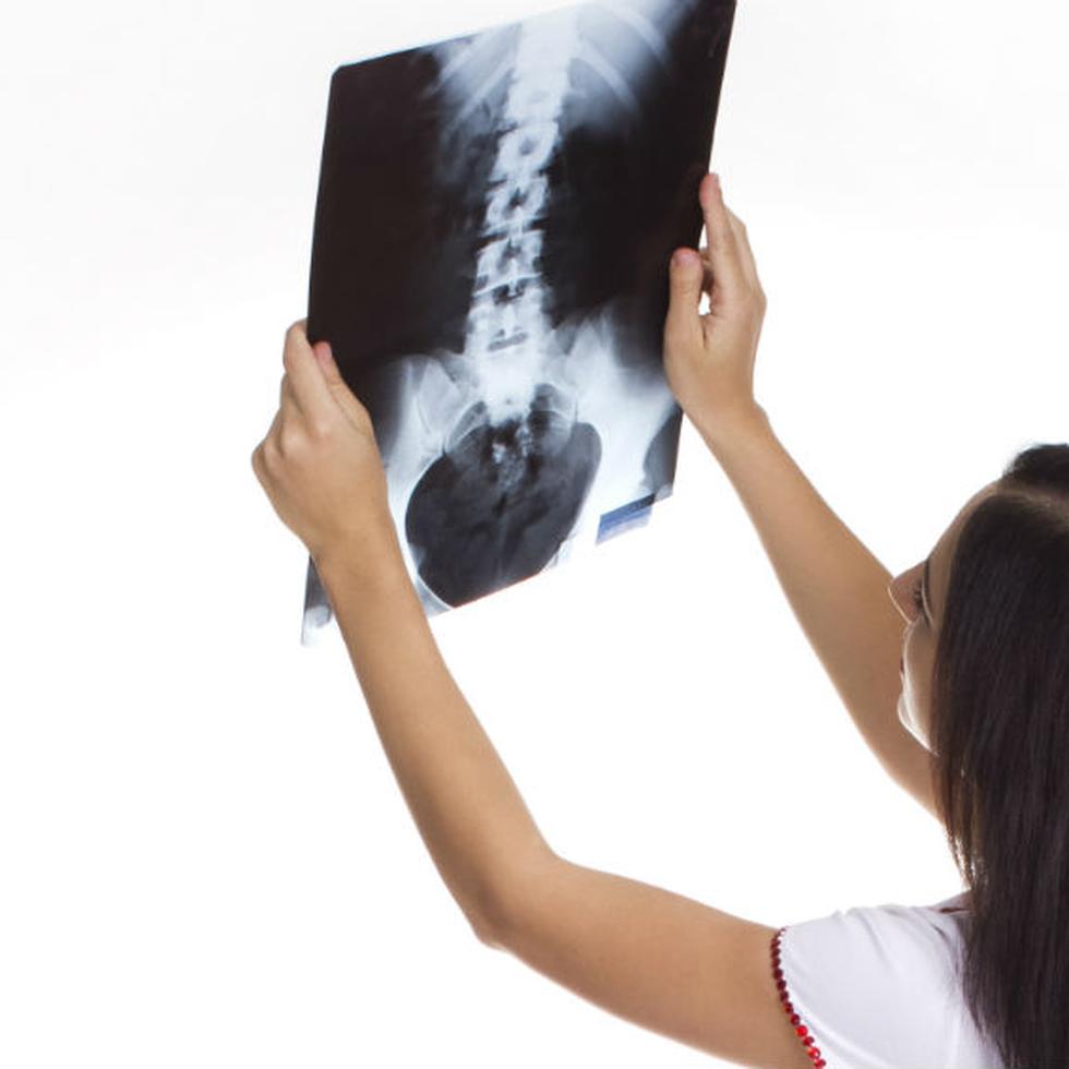 Las fracturas son, sin duda, la principal consecuencia de la osteoporosis. (Foto: Archivo/ GFR Media)