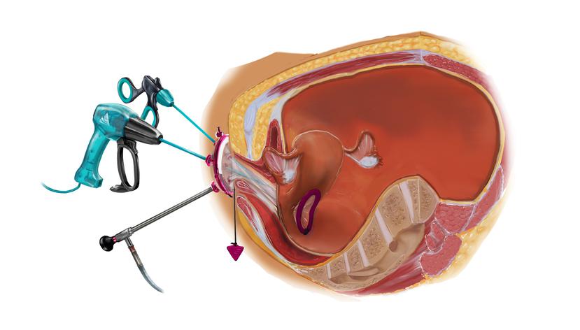 Ilustración de la cirugía endoscópica transluminal, que se hace a través de orificios naturales o vNotes.