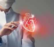 La oclusión total crónica es el espectro más severo de enfermedad cardiaca ateroesclerótica en la que una arteria coronaria se identifica como completamente bloqueada.