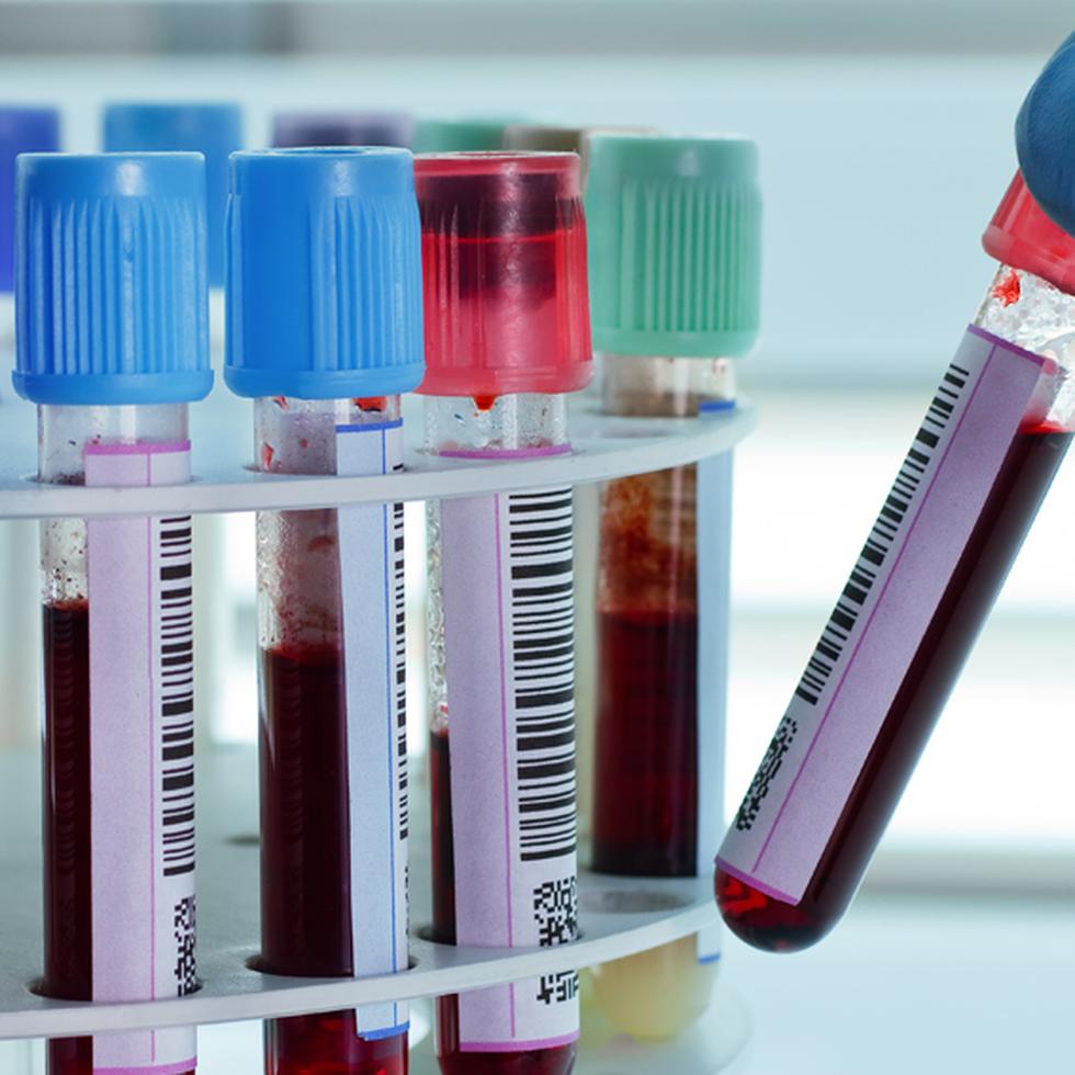 Antes de que la prueba pueda usarse, los investigadores deben determinar qué nivel de neurofilamento en sangre es demasiado alto. (Shutterstock)