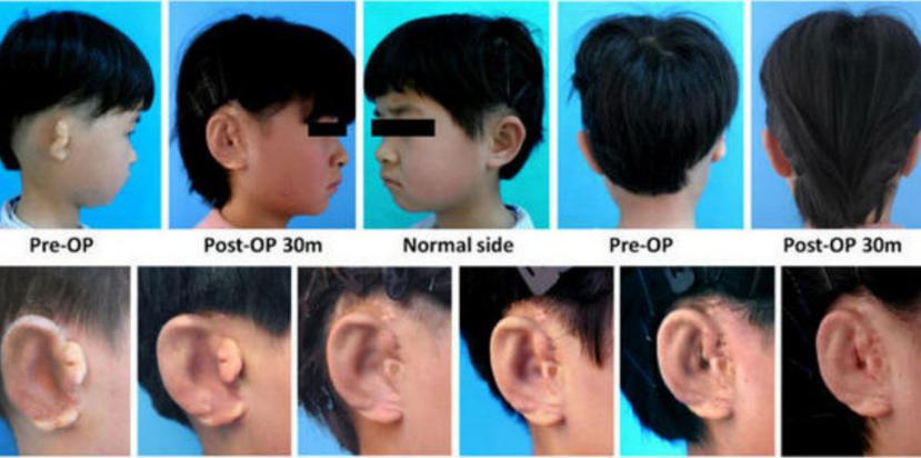 Mediante estas fotografías, los científicos mostrar el avance del crecimiento de la oreja. (ebiomedicine.com)