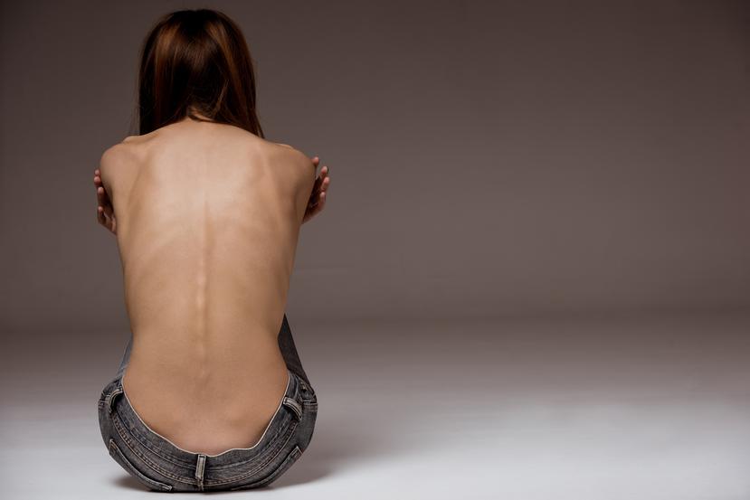 Se pone de manifiesto la necesidad de ver la anorexia no solo como un trastorno mental, sino como una enfermedad con muchos factores implicados. (Shutterstock)