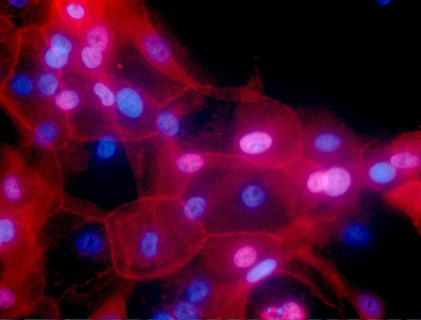 Imagen de las células del cáncer de mama. (AP)