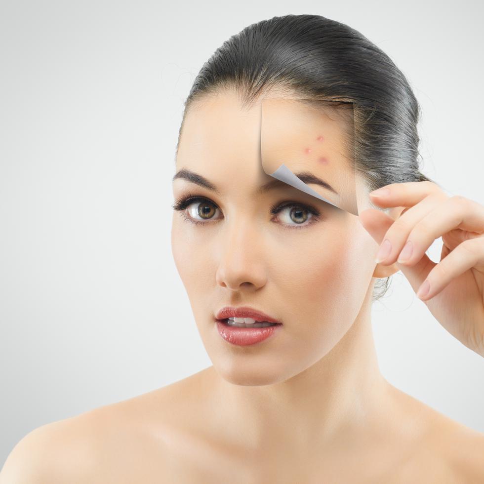 Existen muchos mitos alrededor del tema del acné.