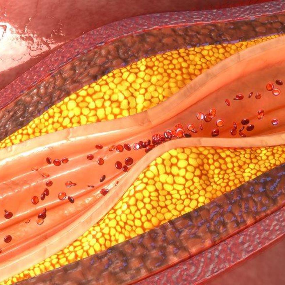 La aterosclerosis subclínica progresa cuando los niveles de colesterol y la tensión arterial están elevados, (Shutterstock)