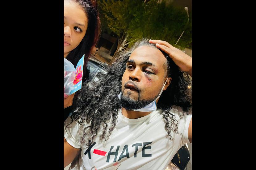 Denorver "Dee" Garrett muestra una lesión tras recibir varios puñetazos de un policía cerca del Jefferson Square Park en Louisville, Kentucky.