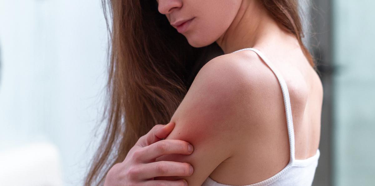 Los efectos de la psoriasis se manifiestan mayormente en el cuero cabelludo, los codos y las rodillas.