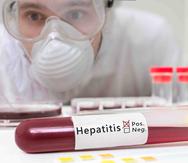 El período de incubación de la hepatitis A dura entre 15 y 50 días y presenta síntomas como fiebre, náusea, vómito, falta de apetito, ictericia y dolor en las articulaciones. (Archivo/ GFR Media)