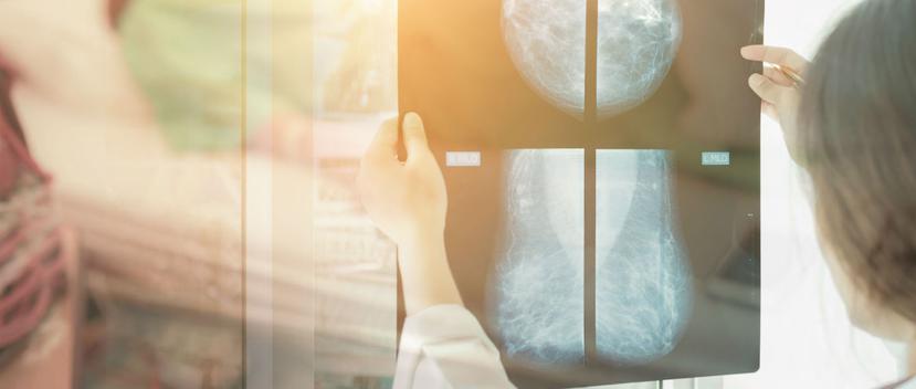 La mamografía es el mejor estudio para detectar las microcalcificaciones, que son la forma más temprana en la que se puede ver el cáncer de seno. (Shutterstock)