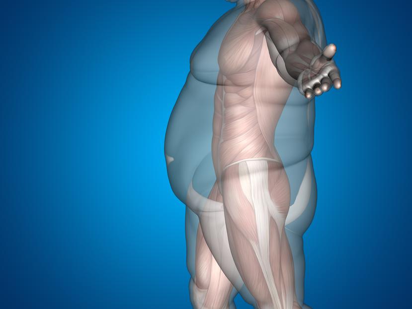 La obesidad es una enfermedad crónica y puede tener repercusiones de gravedad, escribe José Cruz López.

