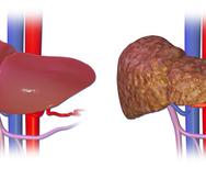 A la izquierda, un hígado sano y a la derecha, con cirrosis.