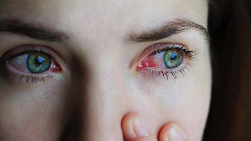 La primera señal son los ojos rojos, seguido de lagrimeo constante, comezón, ardor y sensación de tener algo en el ojo. (Mylene2401 from Pixabay)