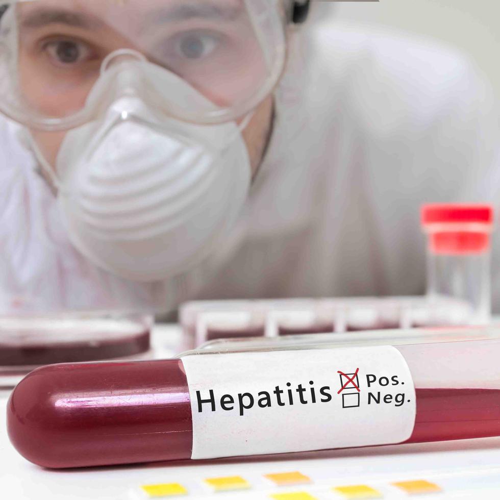 El período de incubación de la hepatitis A dura entre 15 y 50 días y presenta síntomas como fiebre, náusea, vómito, falta de apetito, ictericia y dolor en las articulaciones. (Archivo/ GFR Media)