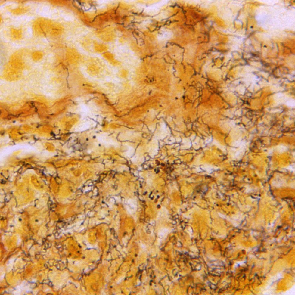 Esta fotografía de microscopio de 1966 facilitada por los Centros para el Control y la Prevención de Enfermedades de Estados Unidos enseña una muestra de tejido con la presencia de numerosas espiroquetas de Treponema pallidum, la bacteria responsable de causar la sífilis, en forma de sacacorchos y teñidas de oscuro.
