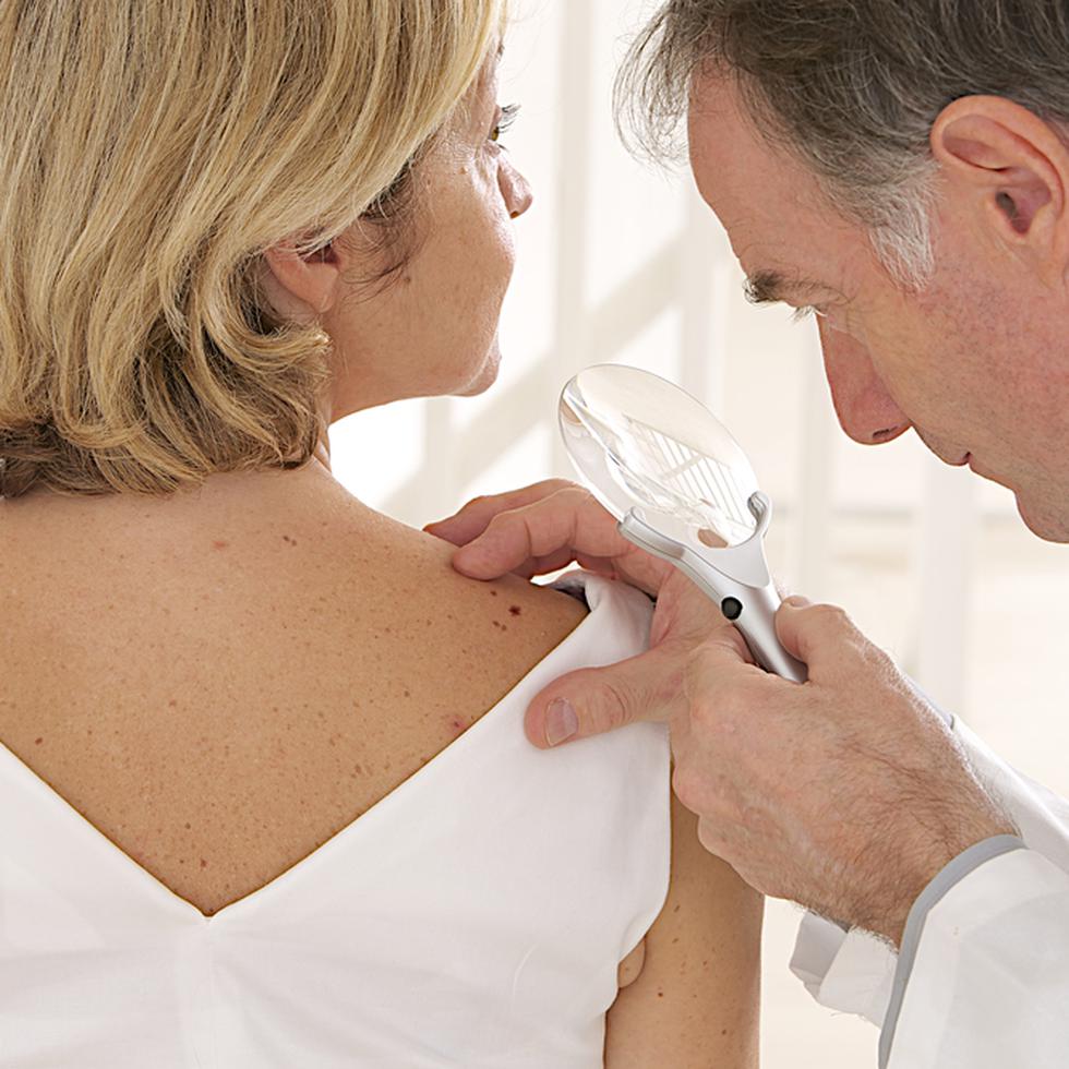 Lunares irregulares son algunas de varias señales de alerta del cáncer de piel.
