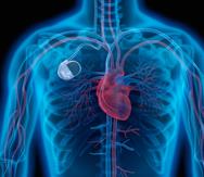 Los desfibriladores son dispositivos eléctricos que se implantan bajo la piel del paciente y poseen, por lo menos, un cable que utiliza constantemente para analizar el ritmo cardíaco.
