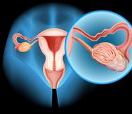 Los síntomas del cáncer de ovario pueden confundirse con molestias relacionadas al período ovulatorio.