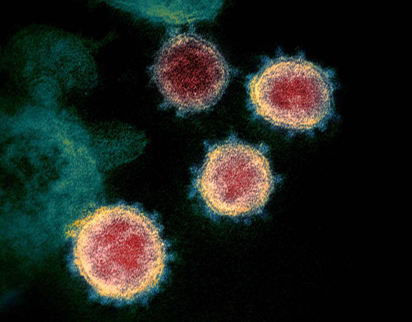 Una muestra de coronavirus recogida de uno de los primeros casos en Estados Unidos.
(Elizabeth R. Fischer/Laboratorios Rocky Mountain del Instituto Nacional de Alergias y Enfermedades Infecciosas vía The New York Times)


