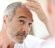 La caída del cabello que afecta a millones de hombres y mujeres se conoce como alopecia.