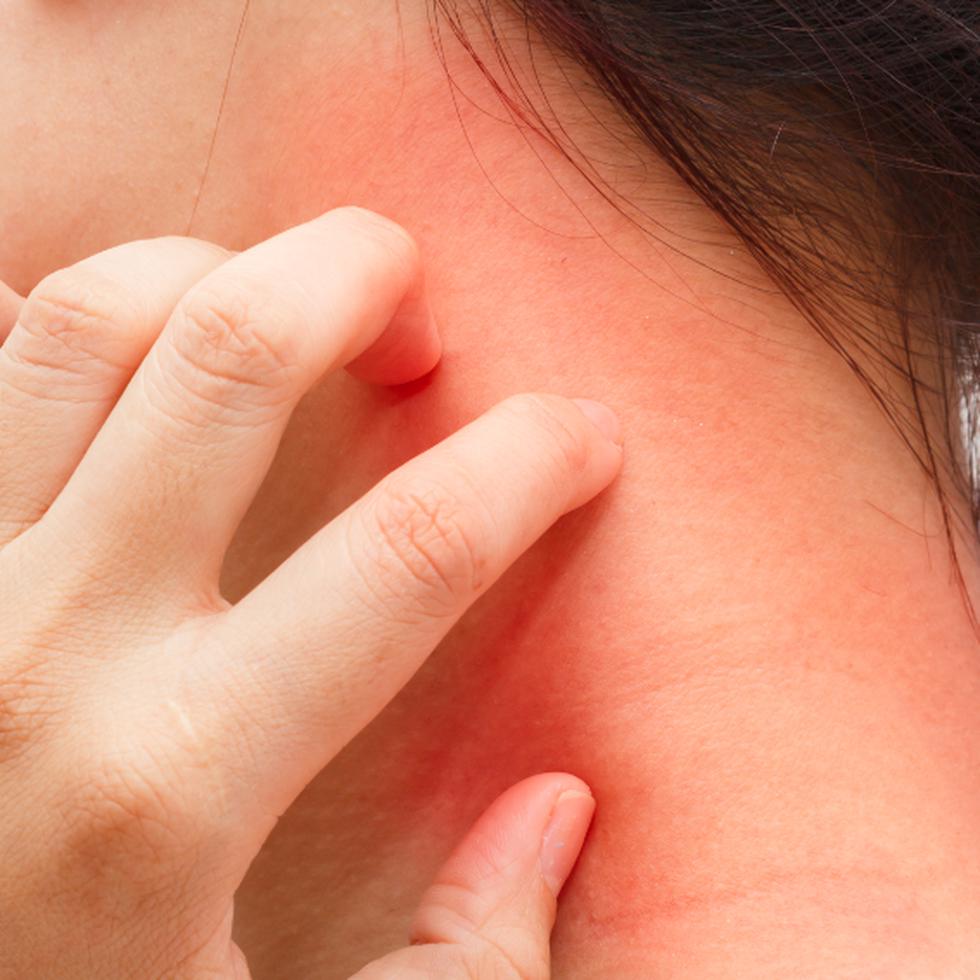 La picazón intensa es común en pacientes que padecen dermatitis atópica. (Archivo)