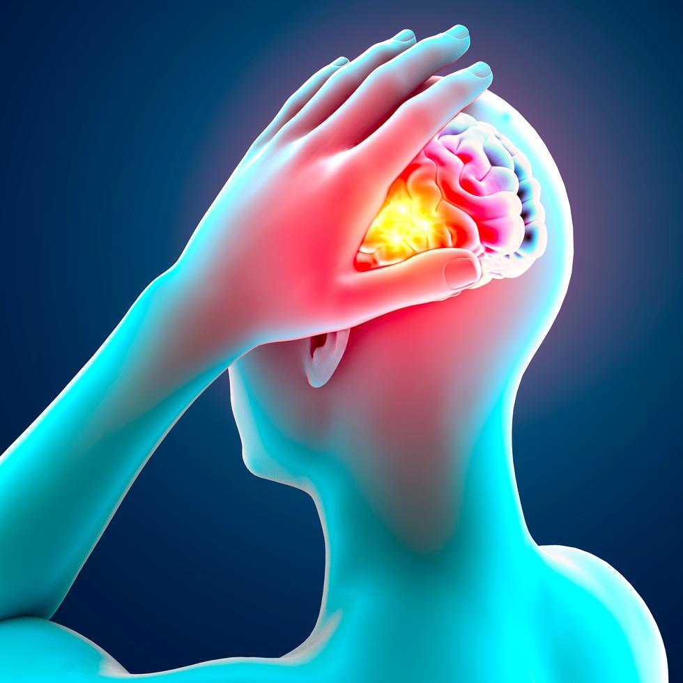 Los síntomas de los aneurismas cerebrales pueden ser diversos e incluyen un dolor de cabeza súbito y severo.