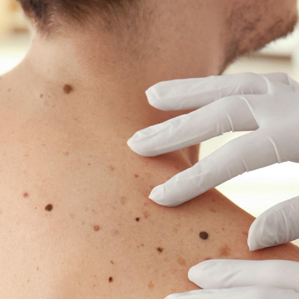 Muchas personas mueren porque sus melanomas se diagnostican cuando están en una etapa avanzada. (Shutterstock)