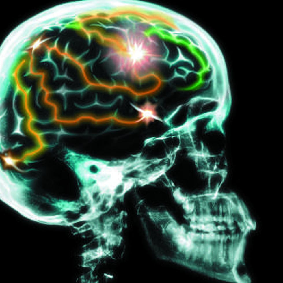 Los problemas de tragado y del habla que los pacientes de ALS presentan pueden confundirse con un evento cerebrovascular. (Archivo)