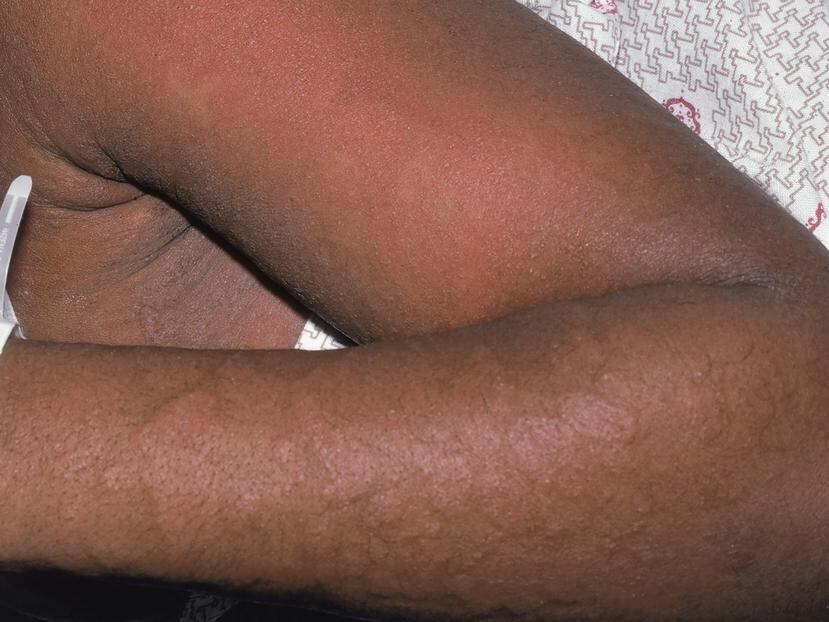 La foto muestra a un paciente que sufre de hipersensitividad inducidad por medicamentos.
