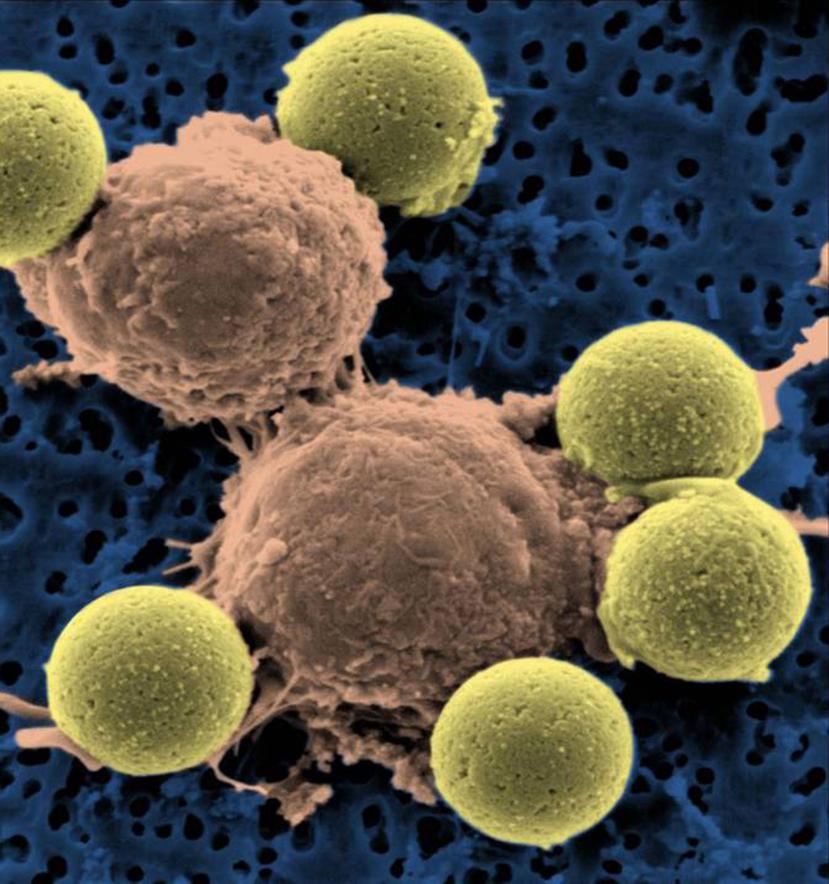 A los pacientes le extraen los linfocitos T, las células que coordinan la respuesta inmune contra virus y bacterias, y las modifican para dirigirlos contra las células tumorales y destruirlas.