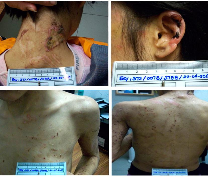 Fotos cedidas por la Procuraduría General de Justicia del Distrito Federal de una joven mexicana con heridas causadas por sus captores que la mantuvieron esclavizada por casi dos años. (EFE)